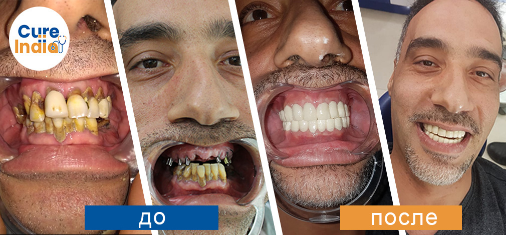 Все на 4 Имплантация зубов в индии - Все на 4 Процедура имплантации